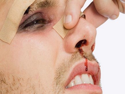Перелом носа які можуть бути наслідки фото і відео