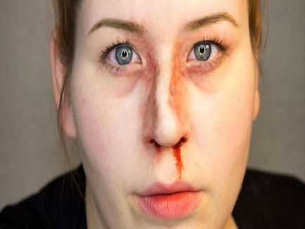 Fractură a nasului care ar putea fi efectele fotografiilor și videoclipurilor