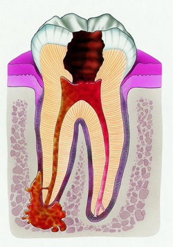 Perodontită și flux peretetic - dinți