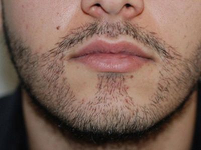 Hajátültetés szakáll módszereit és hatékonyságát, hajátültetés, hogy az arc és a bizonyság