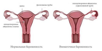 Перші ознаки і симптоми позаматкової вагітності