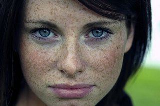 Пігментація шкіри обличчя