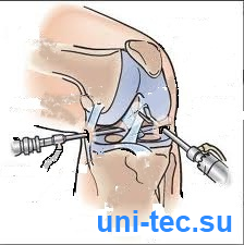 Ligament cruciat anterior