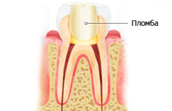 Чому болить зуб після установки пломби