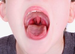 Защо едно дете в съня песъчинки за зъби (бруксизъм) причини и лечение