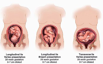 Поперечне положення плода, поперечний і косе положення плоду, причини, вправи, нестійке