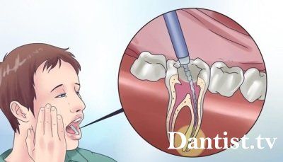 Після пломби болить зуб що робити, причини і лікування