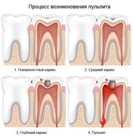 Поставете уплътнението и зъба боли, когато се натисне, за да се направи в такава ситуация,