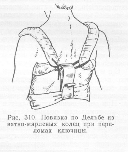 Bandaje pentru fractura de clavicula