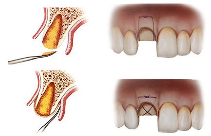 Презервацією лунки зуба