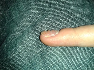 Cauzele și tratamentul unghiilor tubulare pe mâini