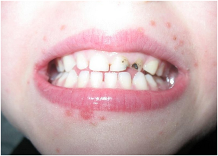 Cauze ale cosurilor de lângă gură