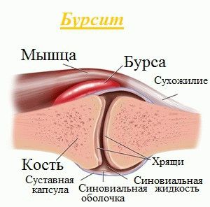 Причини виникнення бурситу і їх особливості