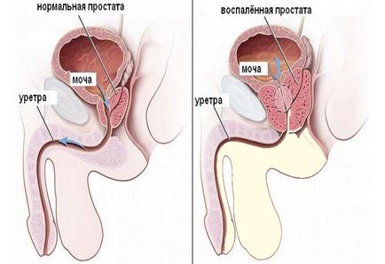 Prostatita la bărbați fotografii, cauze, imagini clinice și tratament