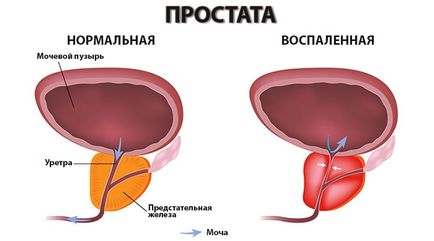 Prostatita la bărbați fotografii, cauze, imagini clinice și tratament