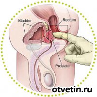 простатит снимки