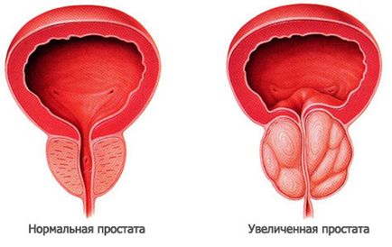 Простатит не вирок, а всього лише діагноз