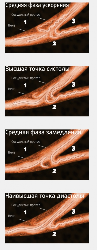 Протези для гемодіалізу, катетери та протези для гемодіалізу, продукція, ооо терсамед, телефон 8 800