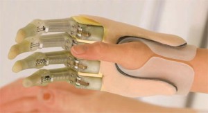 Proteza falangiei degetului inelar al mâinii drepte și stângi în Israel, prețuri, clinici, recenzii