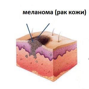 Simptome ale cancerului de piele, semne și tratamente cu medicamente populare