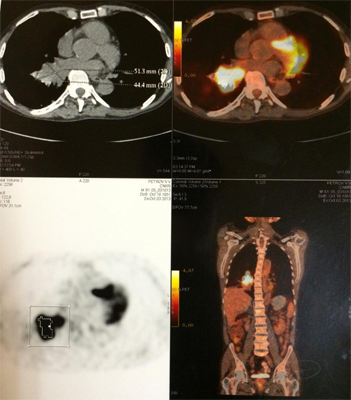 Cancerul pulmonar - simptome, tratament, diagnostic, operație