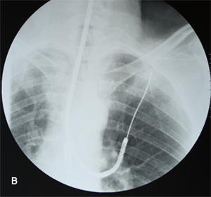 Cancerul pulmonar - simptome, tratament, diagnostic, operație