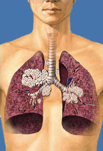 Рак легенів - симптоми, лікування, діагностика, операція