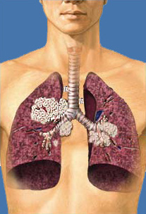 Tüdőrák - tünetek, kezelés, diagnosztikai, sebészi