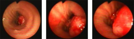 Cancerul pulmonar - simptome, tratament, diagnostic, operație