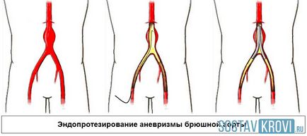 Ruptura aortică a cauzelor cavității abdominale, simptome, intervenții chirurgicale, tratament, diagnostic și prevenire