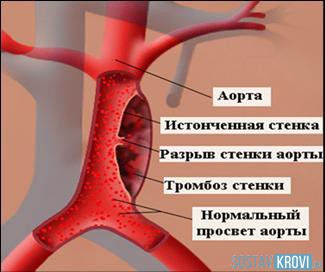 Розрив аорти черевної порожнини причини, симптоми, операція, лікування, діагностика і профілактика