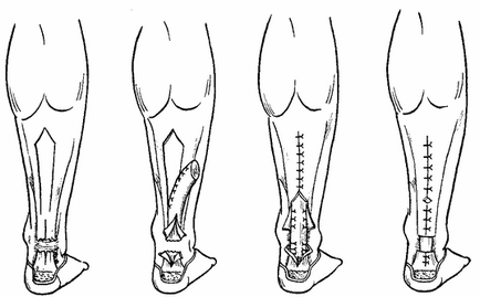 Ruptura tratamentului tendonului lui Ahile și tehnica chirurgiei plastice pe sutura cernavană a cuneo
