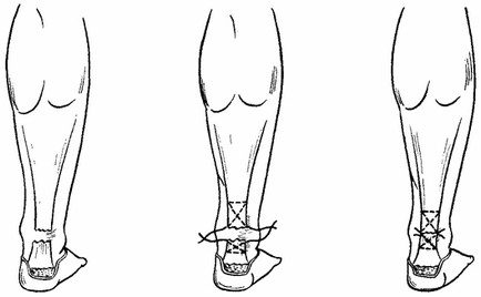 Ruptura tratamentului tendonului lui Ahile și tehnica chirurgiei plastice pe sutura cernavană a cuneo