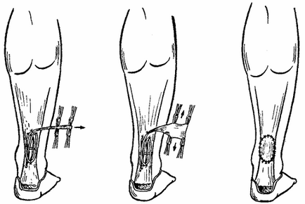 Ruptura tratamentului tendonului lui Ahile și tehnica chirurgiei plastice pe sutura cernavană a cuneo