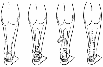 Ruptura tratamentului tendonului lui Ahile și tehnica chirurgiei plastice pe sutura cernavană a cuneo