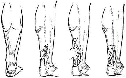 Ruptura tratamentului tendonului lui Ahile și tehnica chirurgiei plastice pe sutura cernavană a cuneo