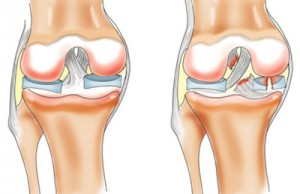 Ruptura ligamentului genunchiului