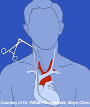 Scopul biopsiei endomocardiale tutorial