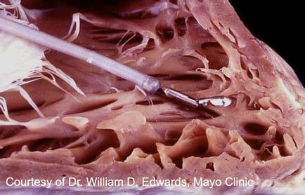 Scvp endomyocardial biopsy tutorial