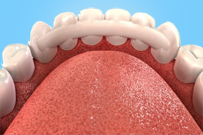 Îmbinarea dinților, dinții mobili și revizuirile după bretele, metode de tratament, stomatologie clară