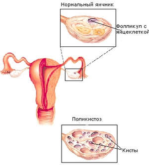 Simptomele disfuncției ovariene (semne) și tratamentul pe bază de plante