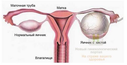 Симптоми кісти яєчника