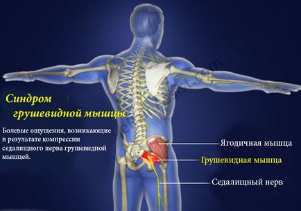 Синдром грушоподібної м'язи як зняти біль у сідницях
