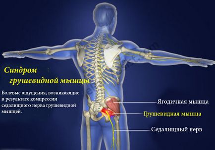 Piriformis szindróma hogyan fájdalomcsillapításra a fenék