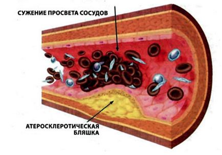 Синдром Леріша - симптоми, лікування, причини, операція