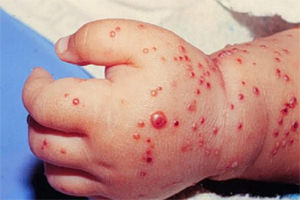 Aureus a belekben a csecsemők Staphylococcus aureus bél csecsemők, újszülöttek