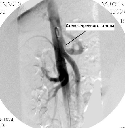 Ateroscleroza atentă a ramurilor viscerale ale tratamentului aortei, operație