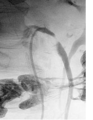 Összehúzó zsigeri ágai aorta atherosclerosis, műtét
