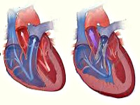 Stenoza gurii arterei pulmonare - cauze, simptome, diagnostic și tratament