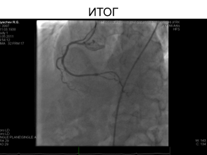 A koszorúér-stent beültetést idős betegeknél - a sajtószolgálat KazNMU